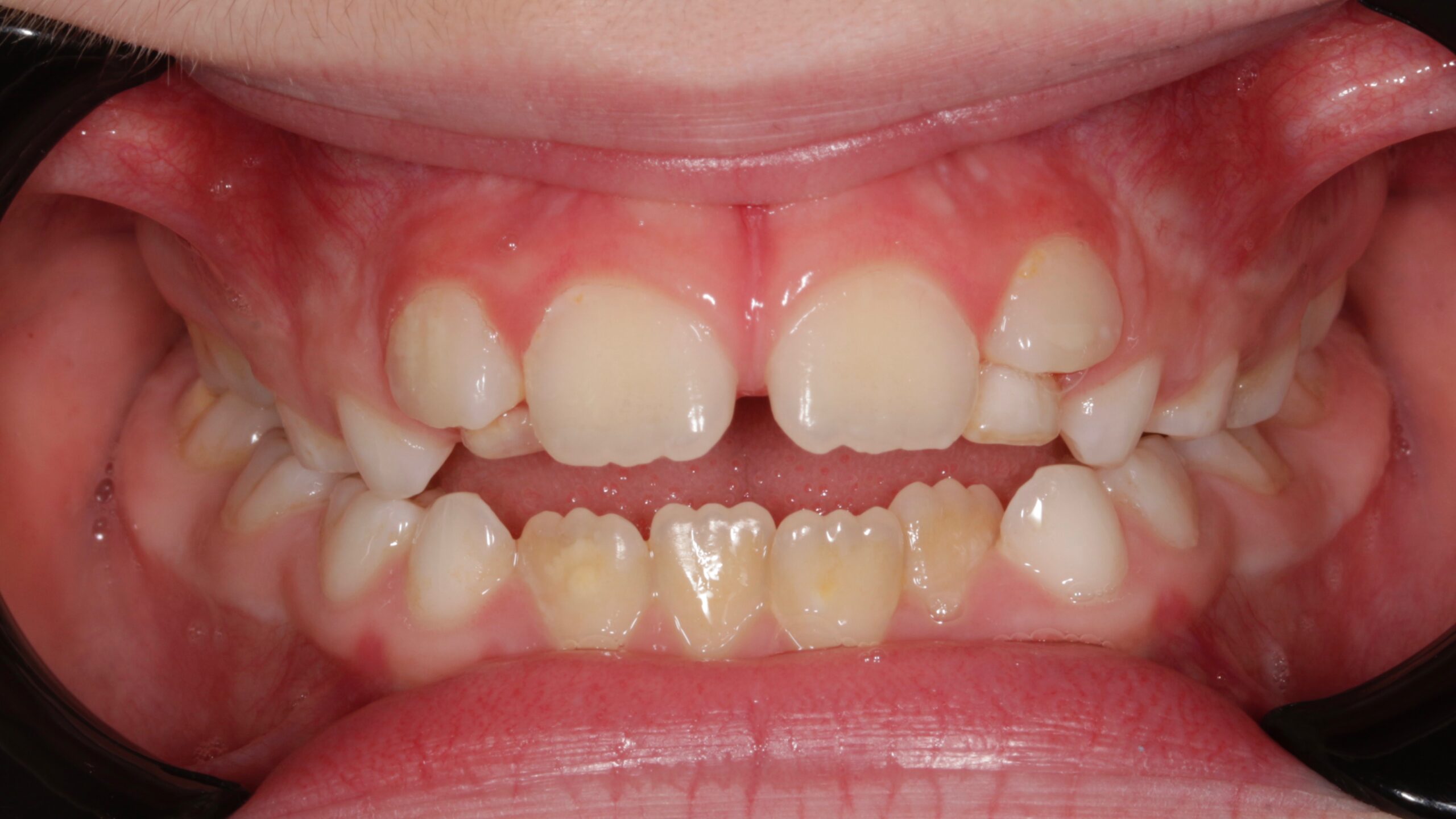 Mordida abierta infantil_ otros problemas dentales