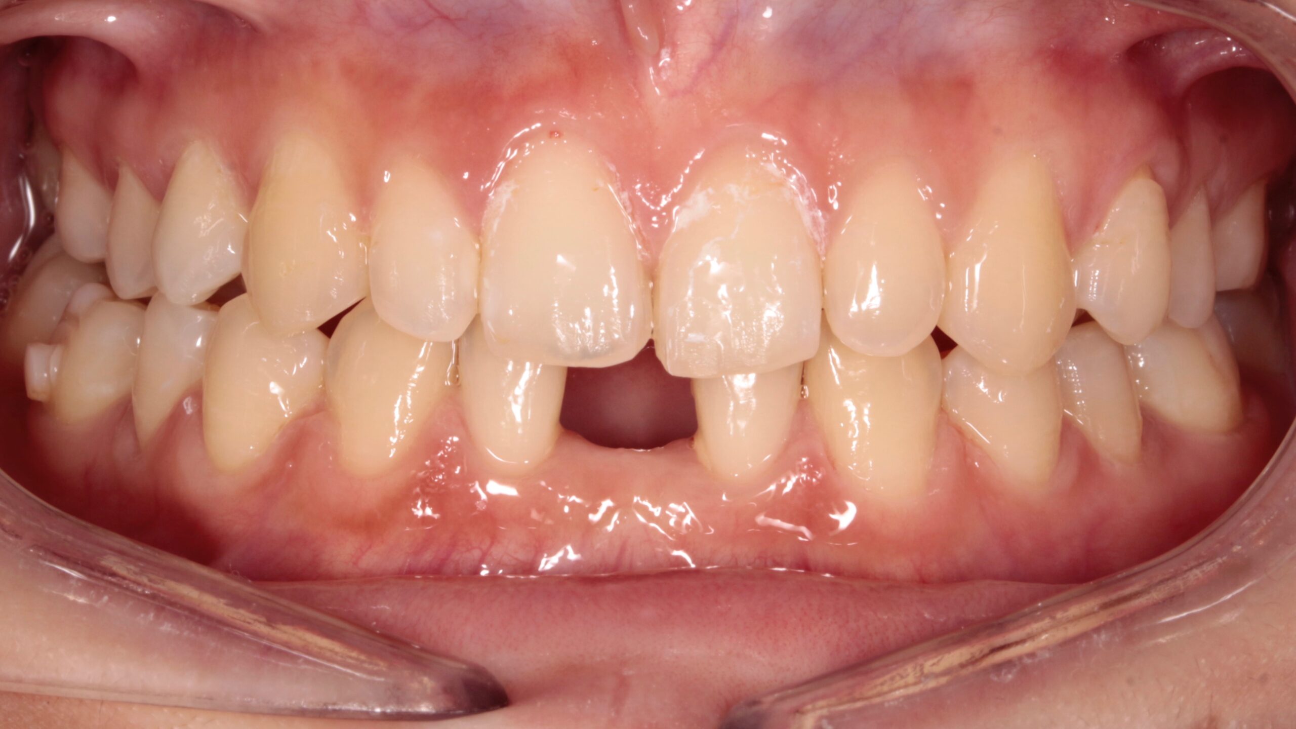 Otros problemas dentales iños 2( agenesia)