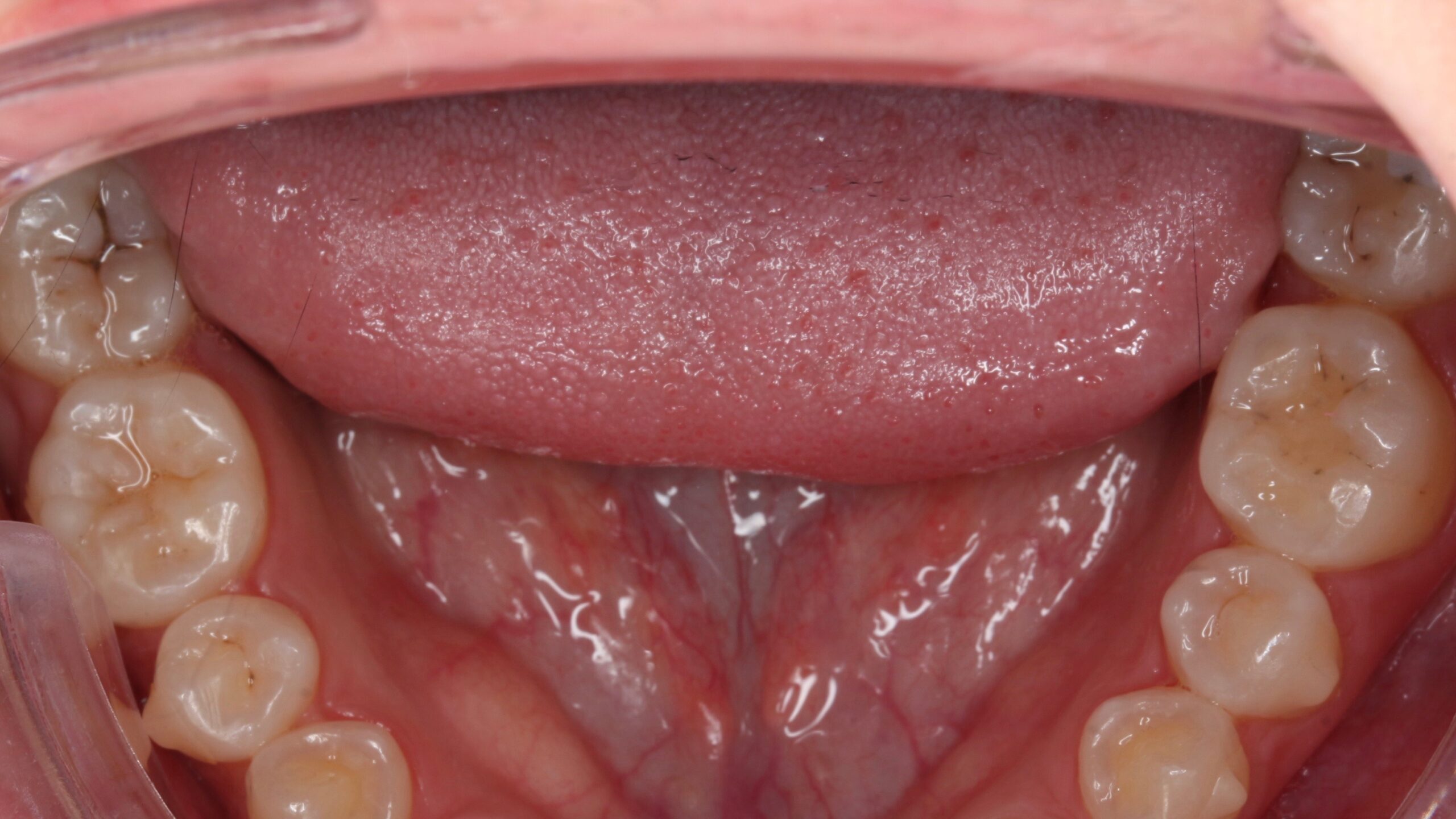 Otros problemas dentales niños 3(agenesia)