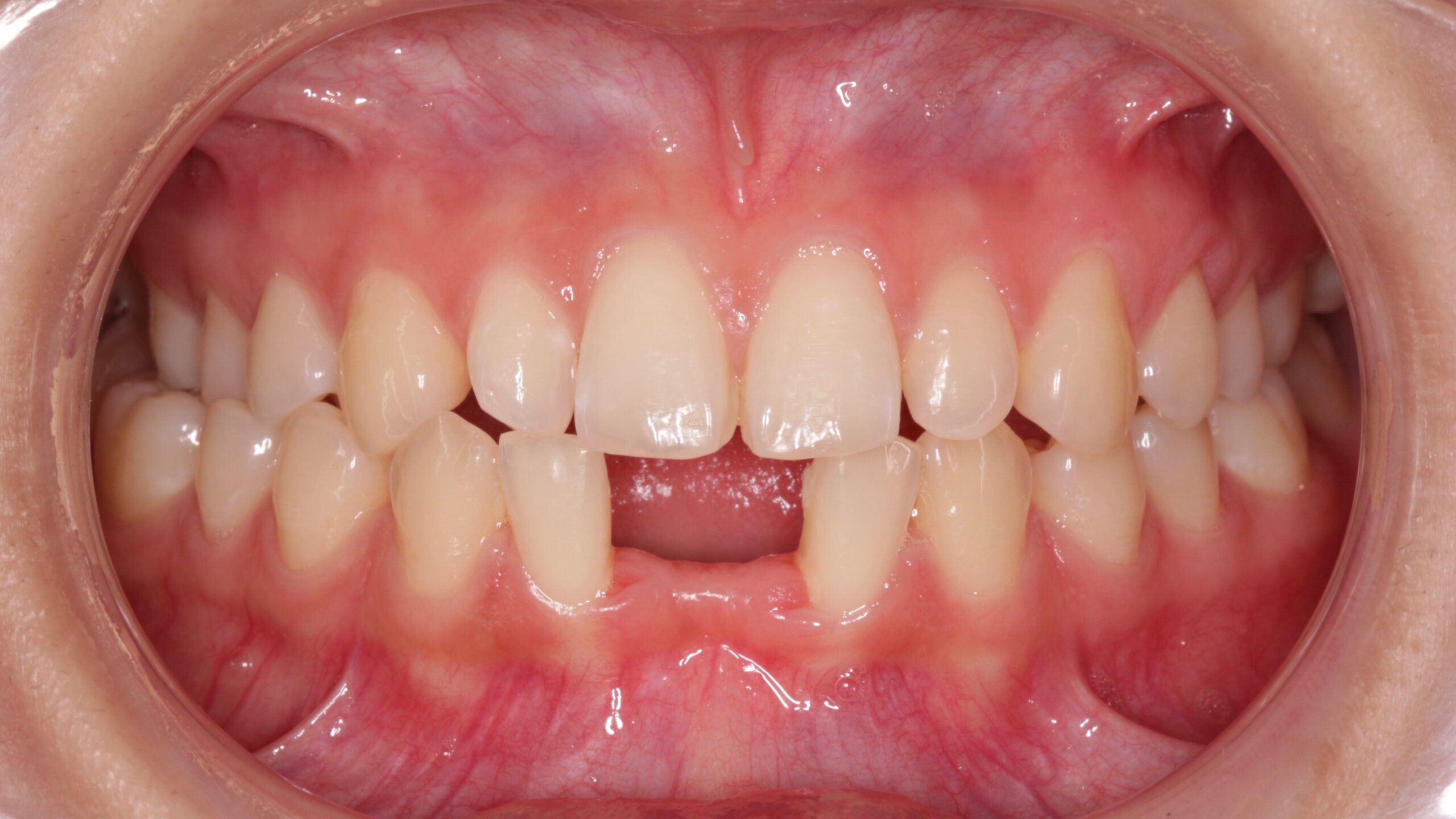 Otros problemas dentales niños1 ( agenesia)